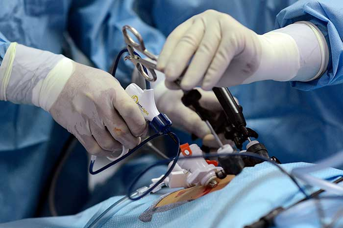 Doctor performing vessel sealer procedure for piles